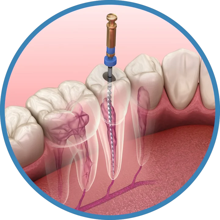 Ilustração de dente com lima endodôntica no canal radicular